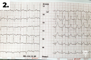  2. první 12svodové EKG