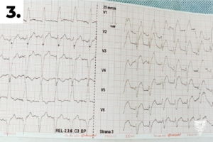 3. EKG 12 svodů před fibrilací komor